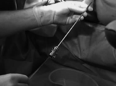 The H Pipelle being used forbiopsy after vaginoscopic or`no touch` hysteroscopy