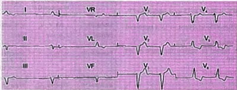 Cardiology Chapter Notes | Medicine - NEET PG