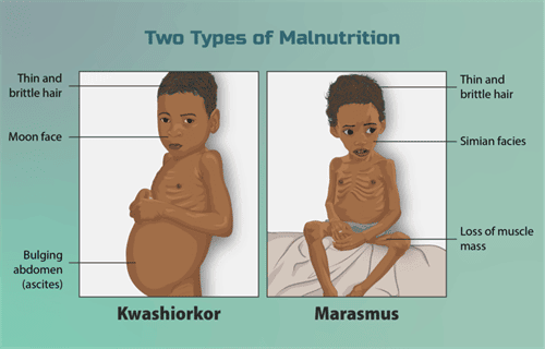 Protein-Energy Malnutrition