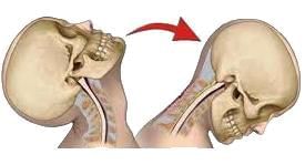 Regional Injuries - 2 Chapter Notes | Forensic Medicine and Toxicology (FMT) - NEET PG