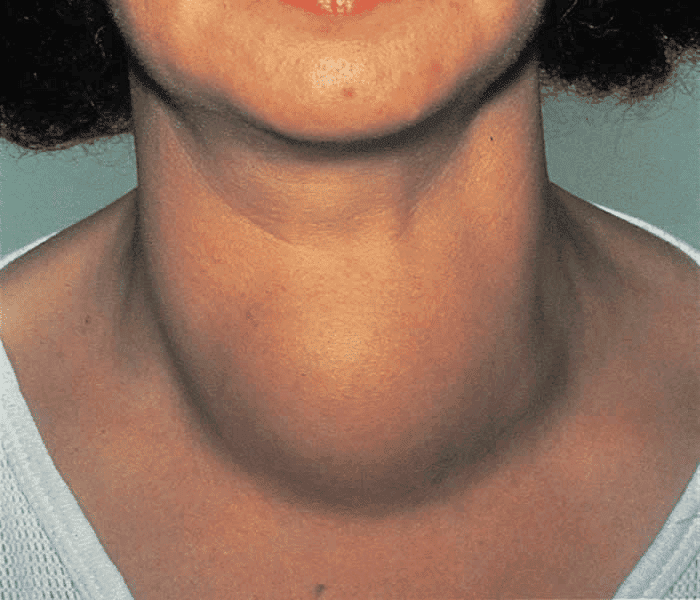 Goitre Disease Symptoms