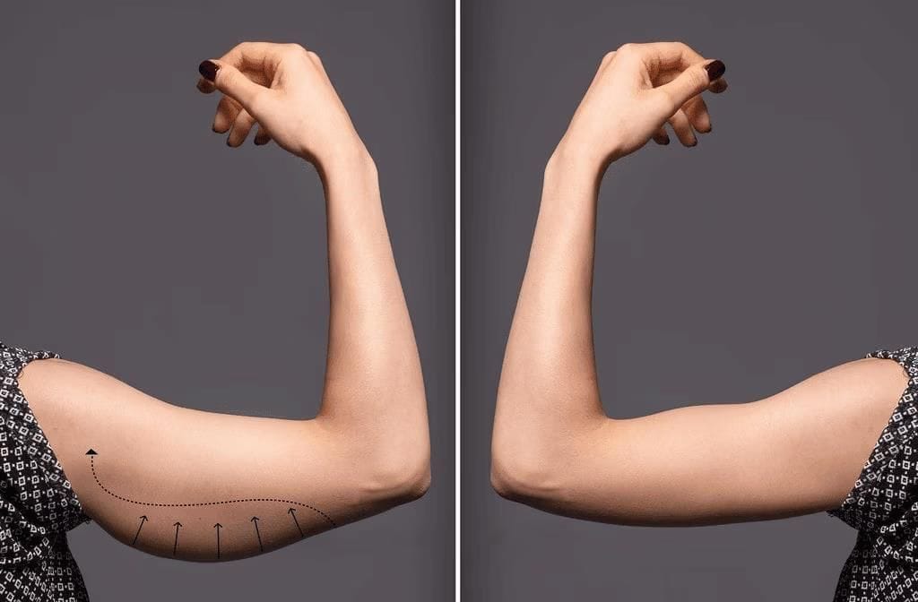 Arm