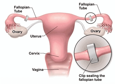 Birth Control, Contraception & Medical Termination of Pregnancy | Biology Class 12 - NEET