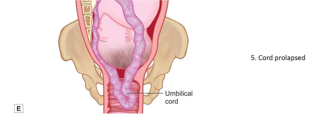 Complications of face presentation