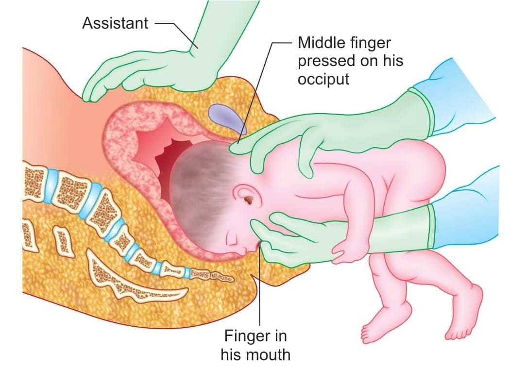 Mauriceau-Smellie-Veit maneuver