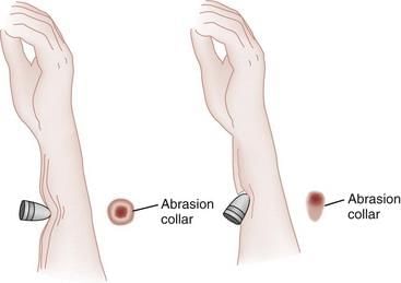 Firearms and Explosive Injuries - 3 Chapter Notes | Forensic Medicine and Toxicology (FMT) - NEET PG