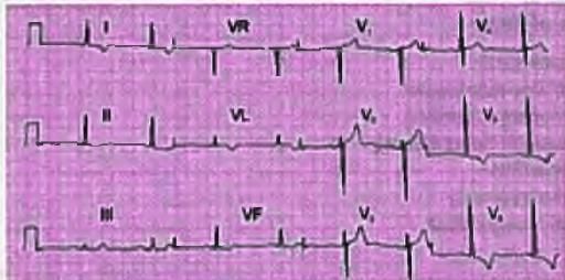 Cardiology Chapter Notes | Medicine - NEET PG