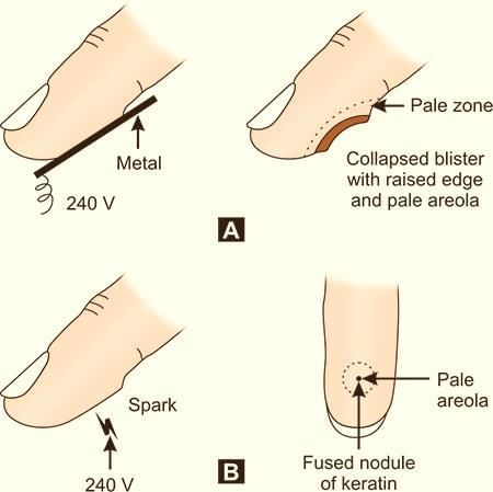 Electrocution Lightning and Radiation Chapter Notes | Forensic Medicine and Toxicology (FMT) - NEET PG
