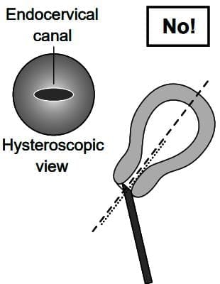 Diagnostic Hysteroscopy