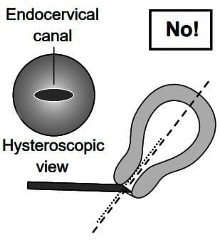 Diagnostic Hysteroscopy