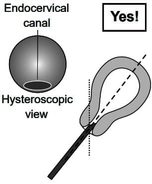 Diagnostic Hysteroscopy